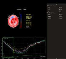Ecocardiografia îngroşarea simetrică/asimetrică a pereților VS > 12 mm disfuncție diastolică: - tip I (relaxare alterată) stadiu incipient - tip III (pattern restrictiv) stadiu avansat funcție
