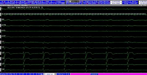 FF = electrograma far-field înregistrată de defibrilatorul intern; A = electrograma atrială înregistrată de electrodul plasat în urechiușa dreaptă; V = electrograma ventriculară înregistrată de