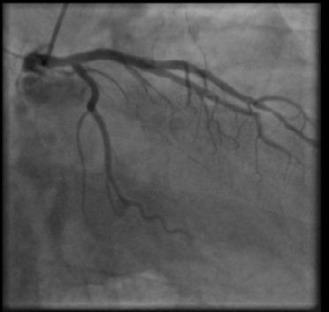 8). Fig. 7. Aspect coronarografic al arterei coronare stângi Fig. 8.