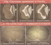 fig,6 partea de josaratacreierul de sobolan( stanga)asupracaruia nu saactionat cu radiatiiionizate, (dreapta) s-a actionat, creierul are schimbarisicavolum.