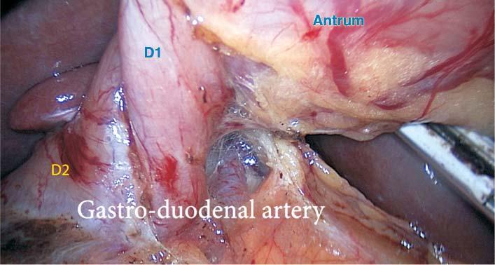 Laparoscopic Pancreas-Sparing Duodenectomy (LPSTD) with Roux en Y Reconstruction for Duodenal Polyposis a very narrow thin CBP (3 mm), the papilla insertion in a common position, and an accessory