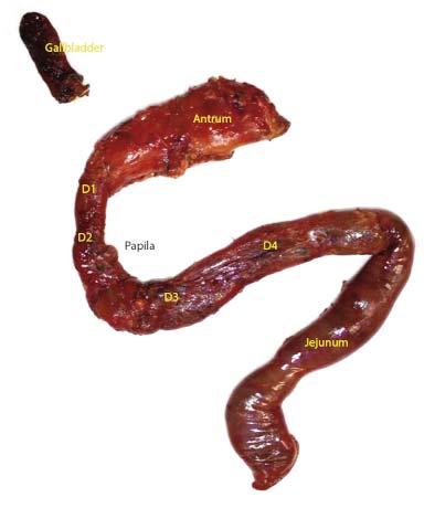 Next, the jejunum is opened, and the second posterior layer is passed at the proximity of the CBD, the main pancreatic duct and Santorini s duct.