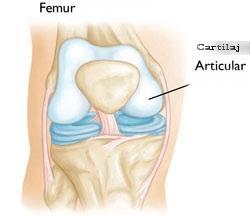 Artroza genunchiului (gonartroza) In mare parte, exista 3 situatii frecvente in care artroza poate aparea - Osteoartrita de genunchi (OA) :este forma cea mai frecventa, fiind un proces degenerativ