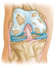 - Artrita reumatoida (AR) : este o artrita inflamatorie, poate aparea la orice varsta si afectarea este comuna la ambii genunchi.