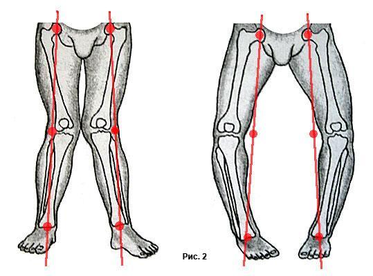 compartimentul medial (interiorul genunchiului) este cel mai frecvent afectat. Aceasta presupune tehnici de rezectie osoasa (femur/tibie) pentru a restabili axa normala a genunchiului.
