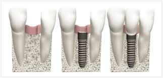 Observatie: acesta este motivul pentru care, dupa extractia unui singur dinte, se pune o lucrarea dentara formata din trei dinti (unul reface pe cel lipsa si doi imbraca dintii vecinii).