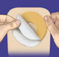 Îndepărtarea dispozitivului de protezare stomică Pregătirea şi aplicarea noului dispozitiv stomic 1. Goliţi sacul stomic atunci când acesta s-a umplut pe jumătate.