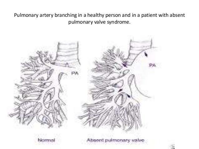 TF cu absenta de VP -3-6% din TF -regurgitare pulmonara severa --dilatatie anevrismala trap si ramuri -compresie