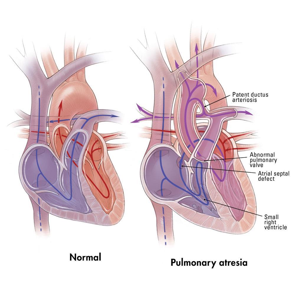 Atrezie pulmonara cu SIV intact < 1% din MCC -VP atretica -infundibulul pulmonar atretic -hipoplazie trap -VD variabil -VT poate fi