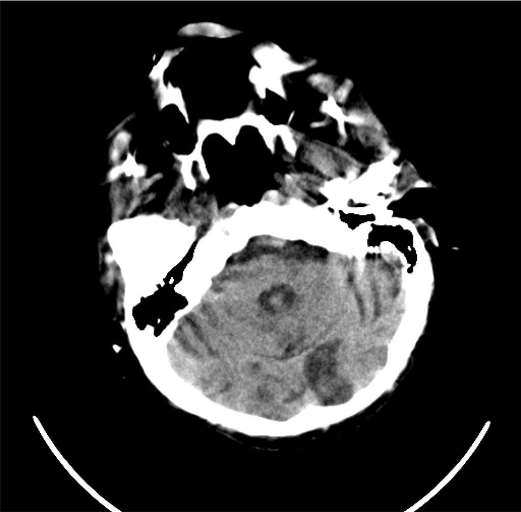 CT craniu, secțiune transversală: accident vascular cerebral cu aspect sechelar occipital