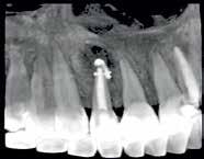 Simion Iulian Anatomie endodontică 2D și 3D cu exemplificarea interesului imagisticii 3D în leziuni endoparodontale folosind softul de reconstrucție Romexis 4.