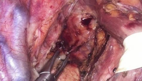 extragerea piesei de esofagectomie subtotală; 5.