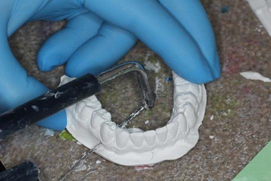 Aparate vacuumformate pentru corecții dentare minore Protocolul de confecționare a acestor gutiere este foarte simplu și necesită