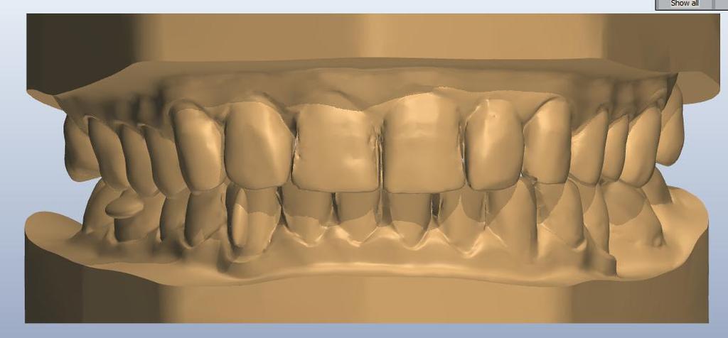 Alignere pentru modificări dentare majore Tratamentul cu astfel de dispozitive presupune un diagnostic complet și o evaluare amănunțită a cazului.