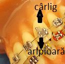 18. APARATE ORTODONTICE FIXE Aparatele ortodontice fixe sunt folosite în domeniul ortodonției în tratamentul atât al copiilor cât și al adulților. Acestea se compun din câteva elemente esențiale: 1.