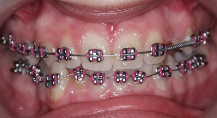 Există multiple clasificări de bracket-uri (dimensiune, material, dimensiunea slotului) astfel încât medicul ortodont poată să aleagă o variantă potrivită în funcție de particularitatea cazului