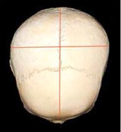 Indicele cefalic - reprezintă raportul dintre lungimea și lățimea maximă a craniului - se calculează după următoarea formulă (fig.