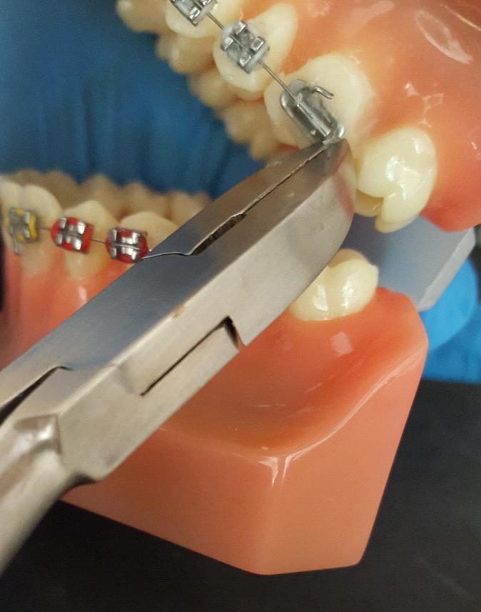 19. MANOPERE SIMPLE DE URGENŢĂ ORTODONTICĂ ÎN TERAPIA FIXĂ Există o serie de urgențe ortodontice care trebuie cunoscute de orice medic dentist, în eventualitatea în care pacientul nu poate să ajungă