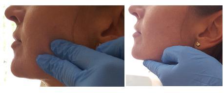 Palparea internă: un deget în vestibulul bucal (M2,M3) spre superior spre zigoma; sunt sensibili în bruxism. Fig. 2.