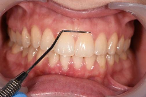 - forma arcadelor: în dentaţia permanentă, ideal este parabola la maxilar și elipsă/semielipsă la mandibulă; formele patologice