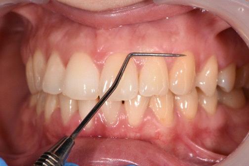 în dentaţia temporară forma arcadelor este de semicerc; orice abatere de la această formă este considerată patologică.