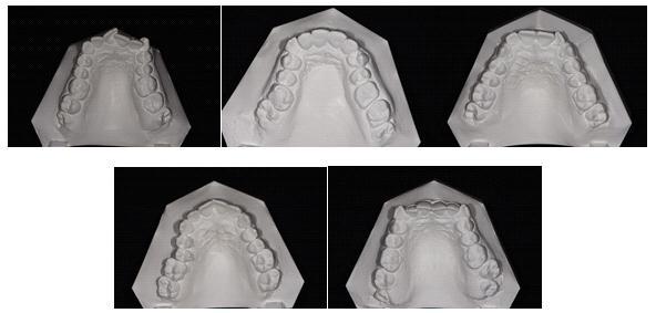Fig. 5. Forme patologice ale arcadei dentare: M, omega, atipică, V, trapez.