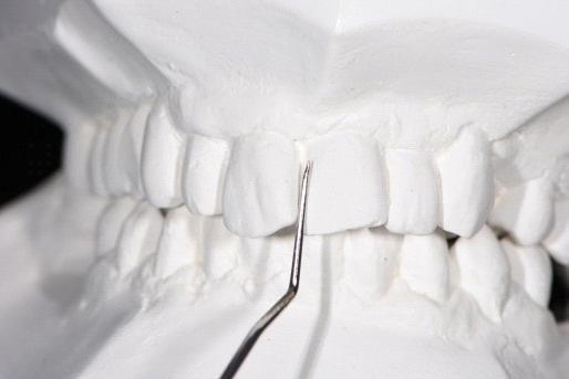 a feţei - variante patologice: laterodevierile liniei interincisive pot fi de cauză dentară