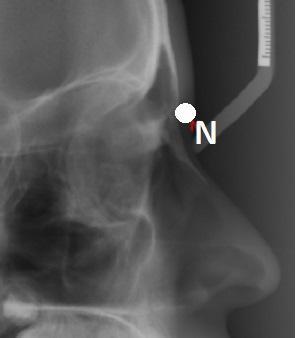 1.1. Puncte osoase NASION (N) Punctul cel mai anterior pe sutura fronto-nazală în plan medio-sagital, corespunde rădăcinii nasului; Punct anatomic, osos, unilateral Localizare: se trasează conturul