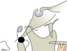 extern Punct anatomic, osos, bilateral Localizare: - radiolucenţă de 3-4 mm, situat aproximativ la înălţimea capului