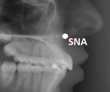 SPINA NAZALĂ ANTERIOARĂ (SNA) Punctul cel mai anterior al spinei nazale Punct anatomic, osos, unilateral Localizare: există o variaţie individuală în lungimea şi înălţimea spinei nazale anterioare;