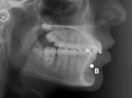 evaluează: Relaţia mandibulei faţă de baza craniului: unghiul SNB Relaţia maxilarului şi mandibulei
