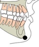 Punctul determinat de bisectoarea unghiului de intersecție a planului facial (N-Pog) cu planul mandibular (Go- Me); Aplicaţii : punct de referinţă în