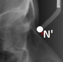 Figura 1.33. Nasion - aspect radiografic Figura 1.34.