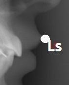 LABIALE SUPERIOR (Ls) Punctul cel mai anterior al marginii buzei superioare Punct cutanat, unilateral Aplicaţii: linia Holdaway pentru evaluarea relației dintre incisivii superiori