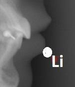 Figura 1.41. Labiale inferior - aspect radiografic Figura 1.42.