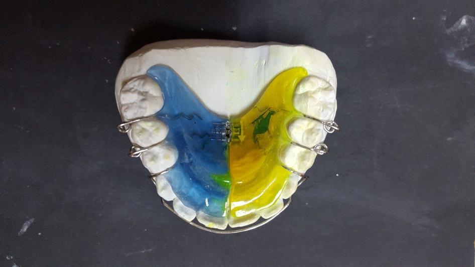12. APARATE MOBILIZABILE În această grupă sunt cuprinse aparatele ortodontice care se ancorează la nivelul arcadelor dentare cu ajutorul unor mijloace de retenție; acestea pot fi croșete sau gutiere.
