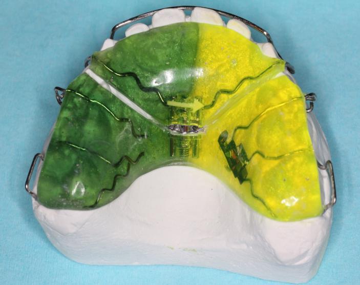 treflă. Croșetele Stahl se utilizează mai mult în dentaţia temporară sau mixtă timpurie (molarii temporari), iar pentru dinţi permanenţi, la mandibulă, deoarece sunt mai puţin voluminoase.