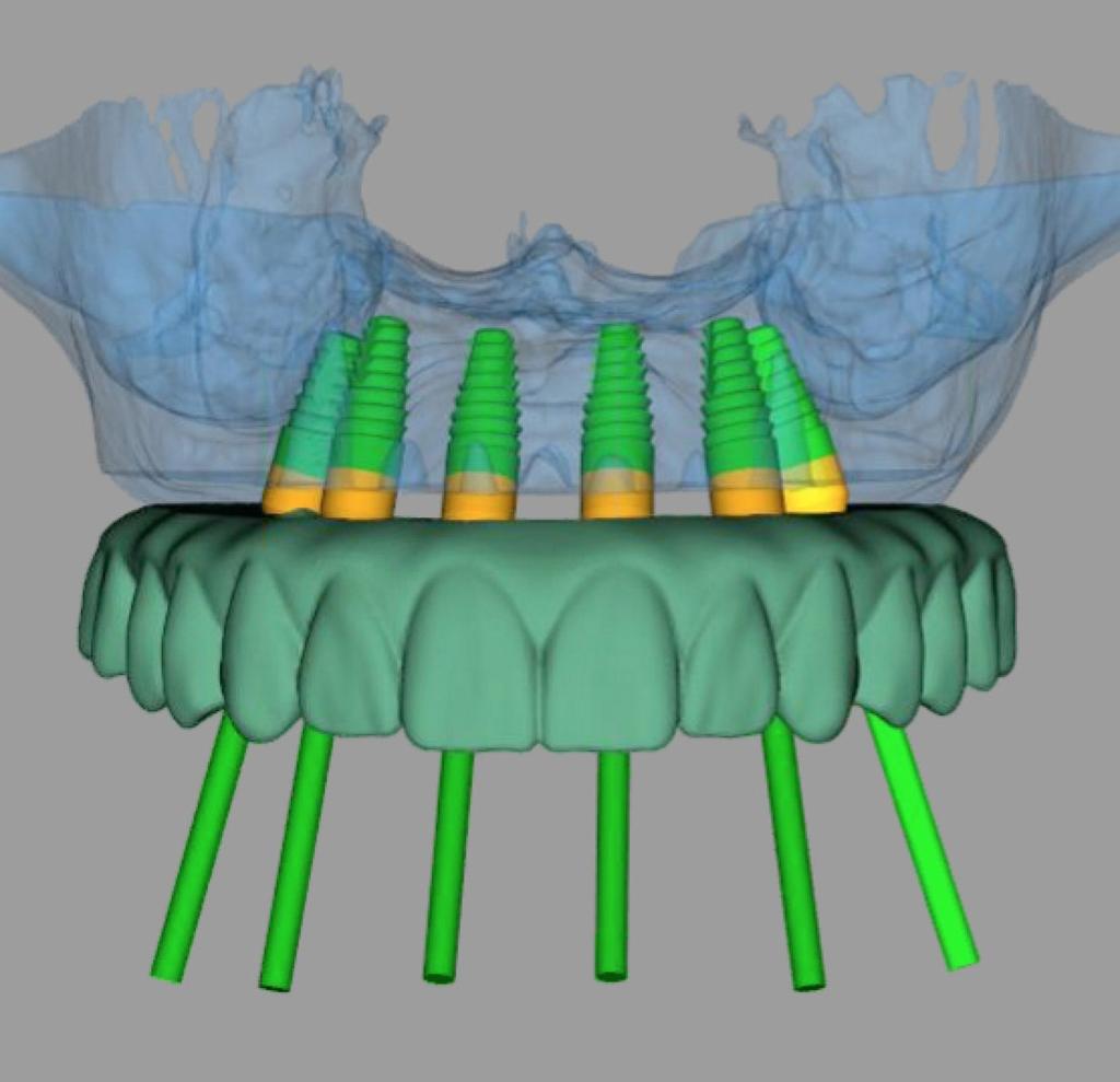 GHID CHIRURGICAL AL IMPLANTULUI DENTAR Un ghid complet chirurgical al implantului dentar incepe cu o raza 3D a gurii si a oaselor acesteia.