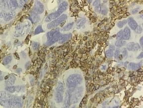 Studii efectuate anterior pe diferite tipuri de malignități epiteliale au arătat că exprimă CD44, inclusiv carcinoamele ovariene, însă rolul acetuia a fost disputat, în