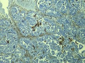 Figura 5.20. Vimentina pozitivă focal în tumoră, pozitivă difuz în fibroblastele stromale, IHC x 10 Figura 5.21.